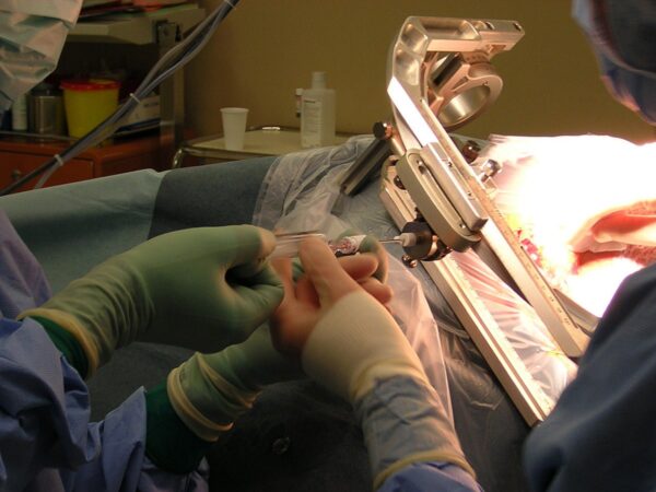 Що таке стереотаксична біопсія та її роль в онкології?